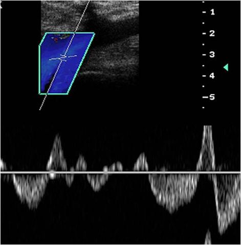 Ultrasondio Doppler